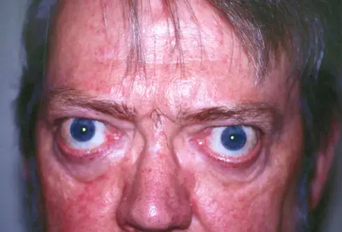 graves-disease.webp