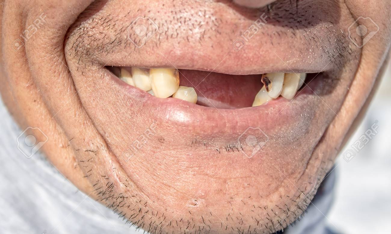 93612766 a man without teeth smiles