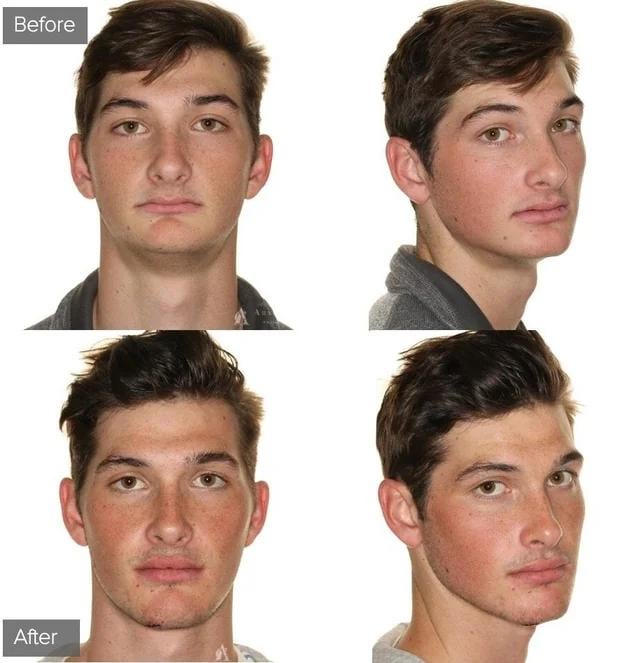 Short face syndrome double jaw surgery why do these results v0 3q7yl4taqx2g1