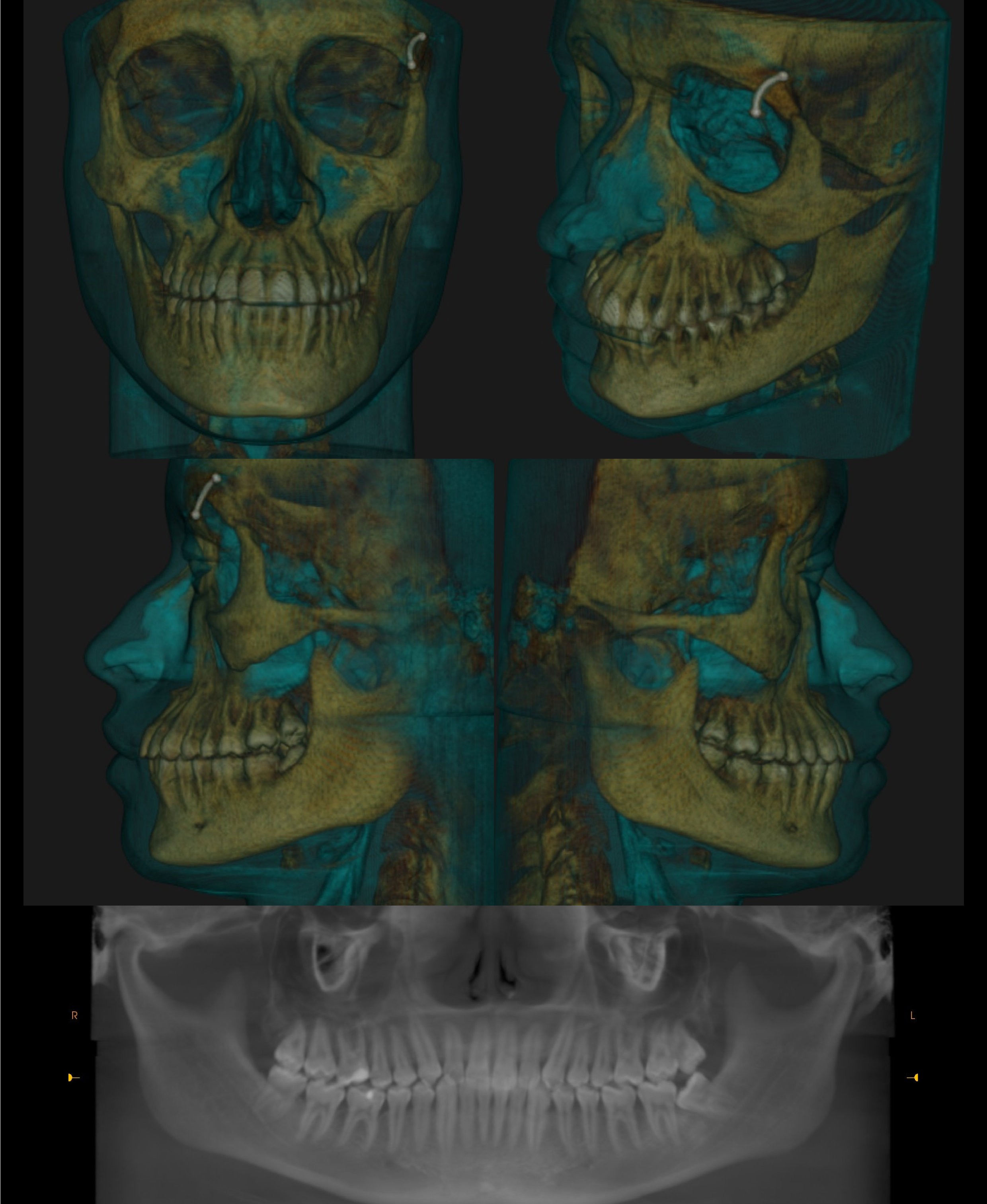 Xray