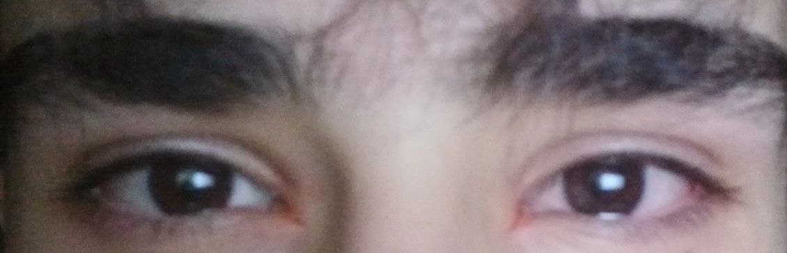 After canthus