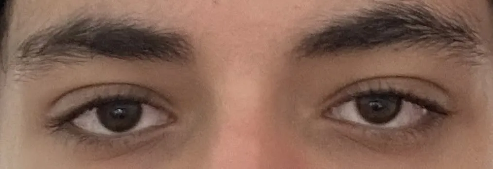 Shitty eye area1