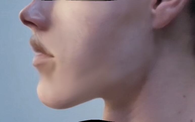Super chin