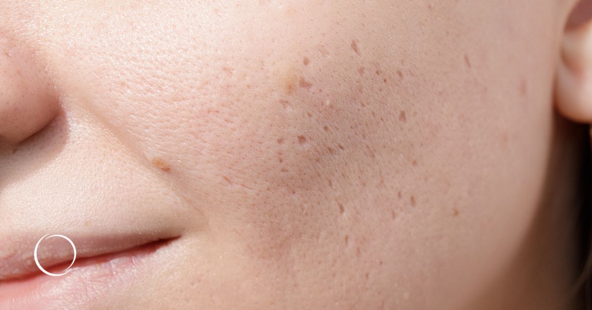 Teenage acne scars