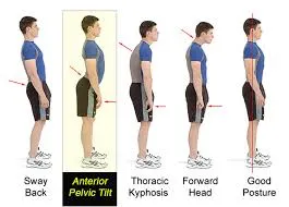 ANT PELVIC TILT PIC