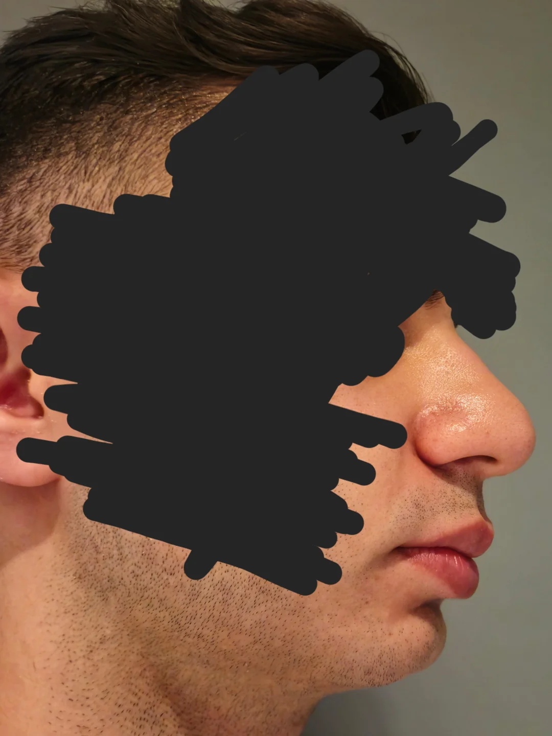 Am i a good candidate for sliding genioplasty v0 o15i77hn7pyd1