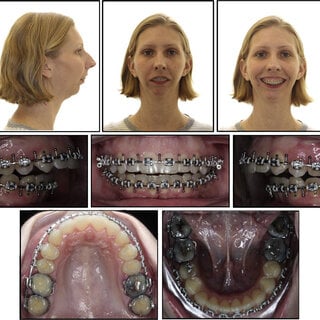 Presurgical orthodontic composite Q320