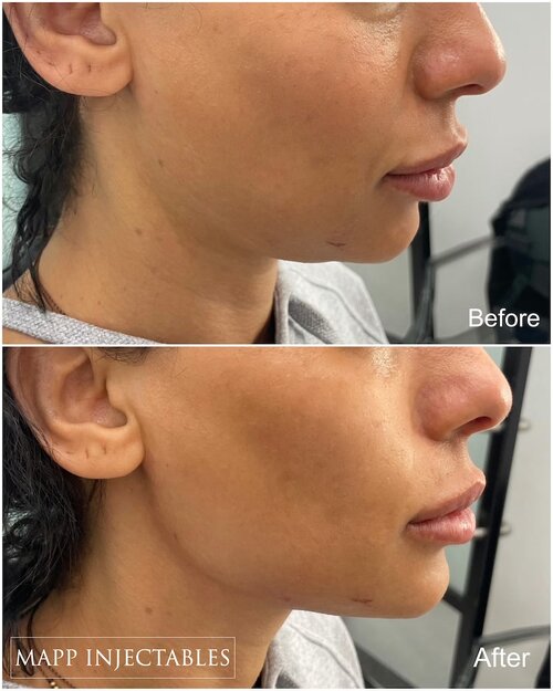 616ced7e68f2907391f6243f_Jawline-filler.jpg