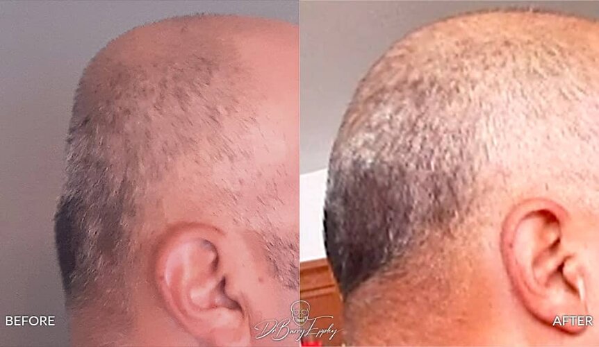 ba-male-flat-back-of-head-custom-skull-implant-result-side-view-Dr-Barry-Eppley.jpg