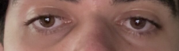 shit eye area.jpg