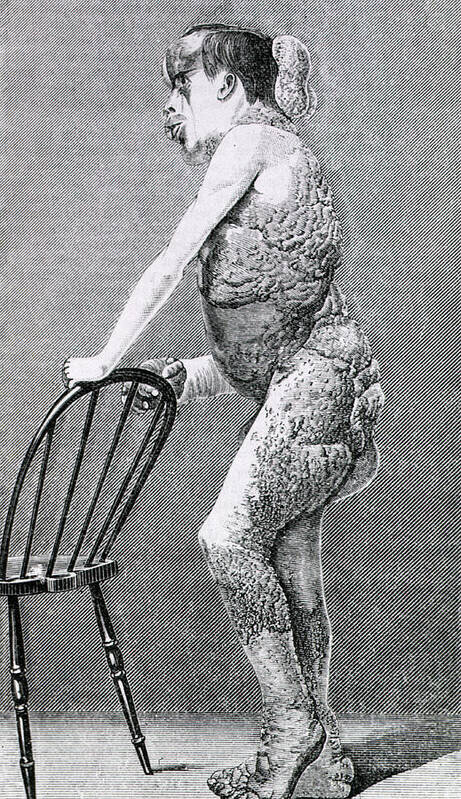joseph-merrick-us-national-library-of-medicinescience-photo-library.jpg