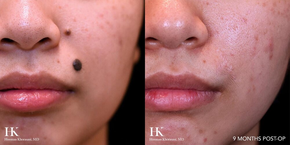 63a0b84fe83740064835b4e7_DrK_Cos_Mole_Removal_Case19_9mon_prepost.jpg