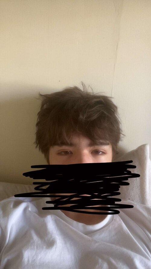 canthal.JPG
