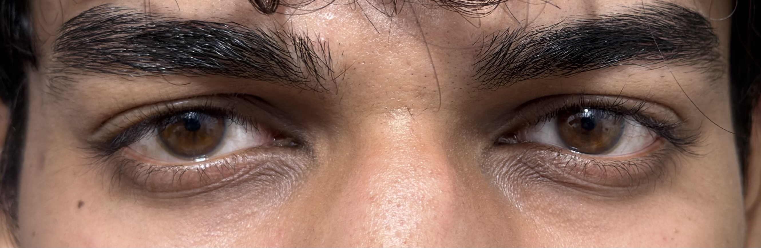 How do i fix my eye area? (Is it over for me?) pls help | Looksmax.org ...